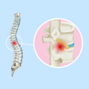 Microscopic Spine Surgery In Chennai