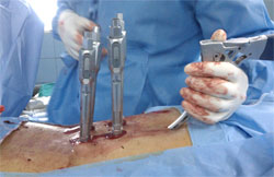 Minimal Invasive Spine Surgery in Chennai