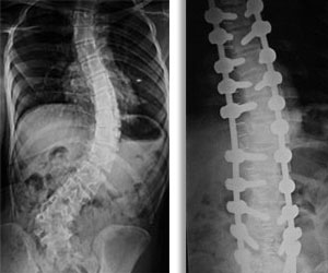 Spine Deformity In Chennai