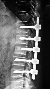 Spine Fractures
