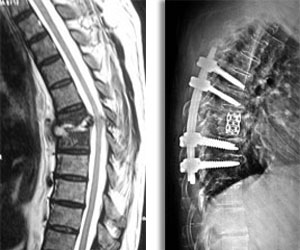 Spine Infection