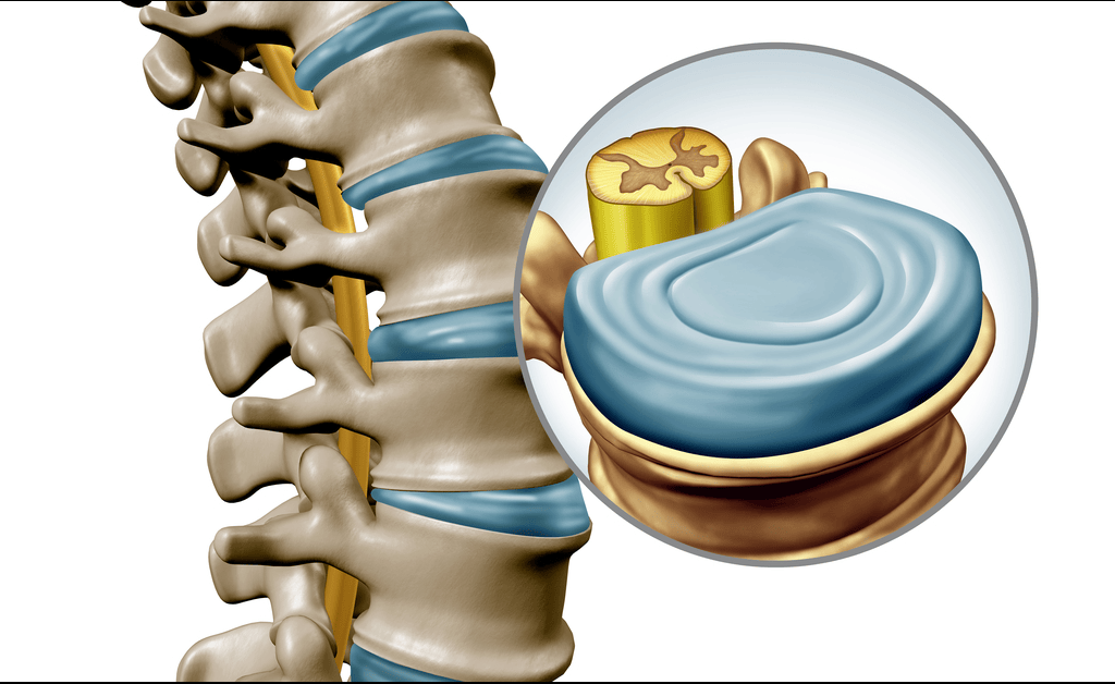 Disc Surgery Specialist Doctor in India